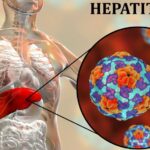 آزمایش هپاتیت آ Hepatitis A (HAV)